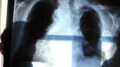 Cancro al polmone aggressivo, combinazione farmaci riduce del 58% rischio morte
