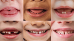 Salute Orale, l’Abc della prevenzione si impara in famiglia