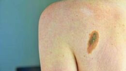 Ok Aifa a immunoterapia in fase precoce per melanoma e carcinoma polmonare