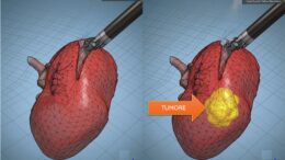 Modelli tridimensionali biomimetici del cancro al rene di un paziente per chirurgia robotica sempre più precisa
