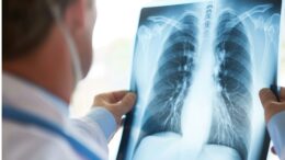 Cancro al polmone, approvato il rimborso di 2 nuove indicazioni per durvalumab