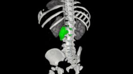 Chirurgia su misura, al Bambino Gesù di Roma rimosso complesso neuroblastoma a bimba di 1 anno