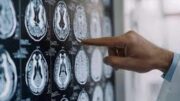 Parkinson, in Italia 300mila persone malate: 10% ha diagnosi prima dei 50 anni