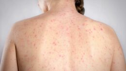 Morbillo, è allarme negli Usa. Italia prima per casi in Europa in in primi 6 mesi 2026
