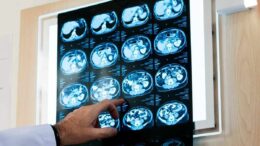Nodulo polmonare: che cos’è, come si diagnostica e quando intervenire