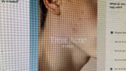Ai prescrive farmaci contro l’acne, esperti Siiam: “Progresso in Medicina non si misura dal numero di decisioni automatizzate, ma dai benefici concreti per i pazienti”