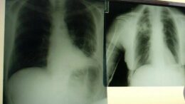 Cancro polmone, con nuova combinazione malattia sotto controllo più a lungo