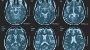 Una persona su 3 ha un disturbo neurologico, a Napoli arriva BrainSpace House