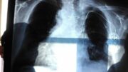 Cancro al polmone aggressivo, combinazione farmaci riduce del 58% rischio morte
